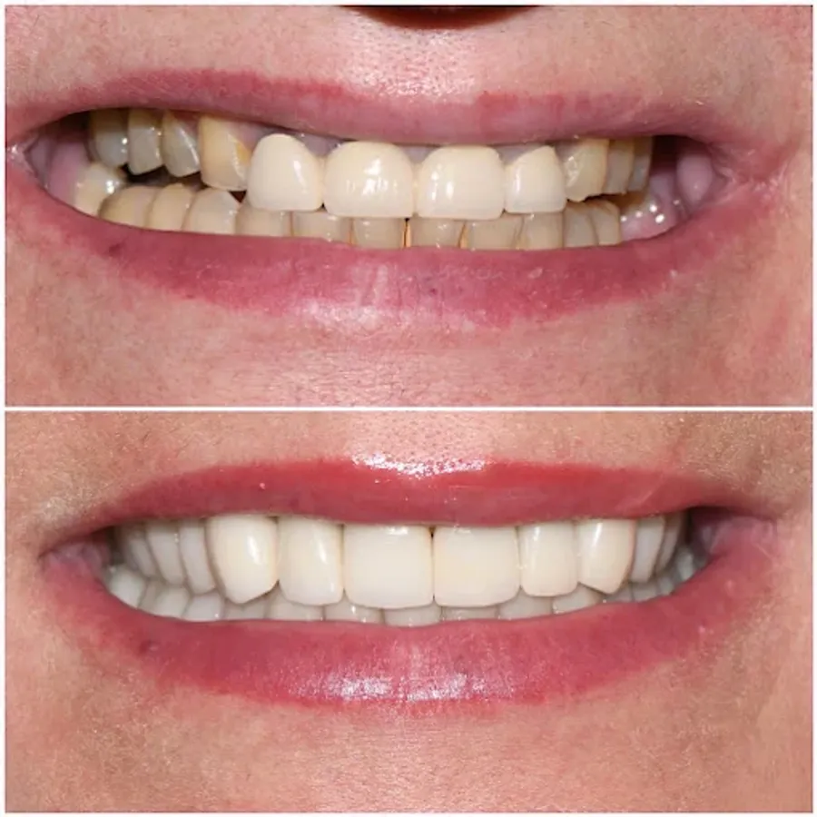 Complex Case Design — before and after at Thrive Dental in Bayside, Queens