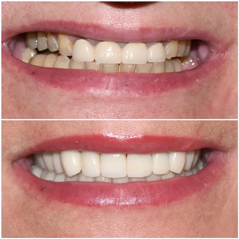 Before and after: Complex Case Design at Thrive Dental in Bayside, Queens