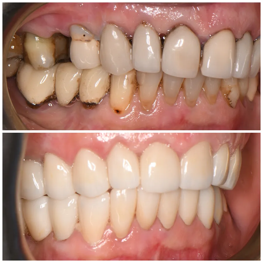 Full Arch Restoration — before and after at Thrive Dental in Bayside, Queens