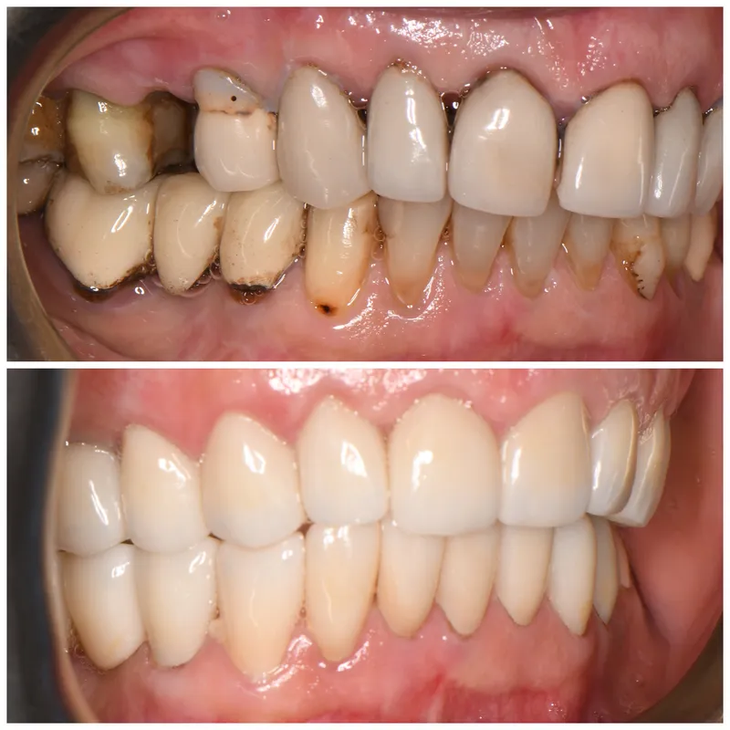 Before and after: Full Arch Restoration at Thrive Dental in Bayside, Queens