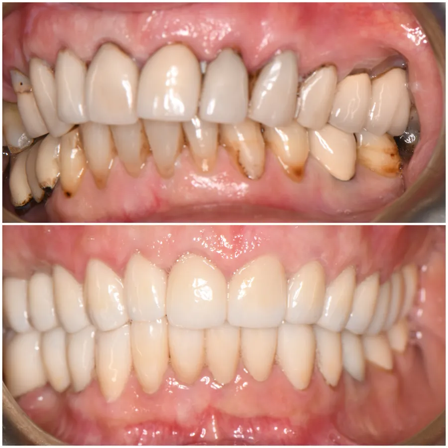 Functional Rejuvenation — before and after at Thrive Dental in Bayside, Queens