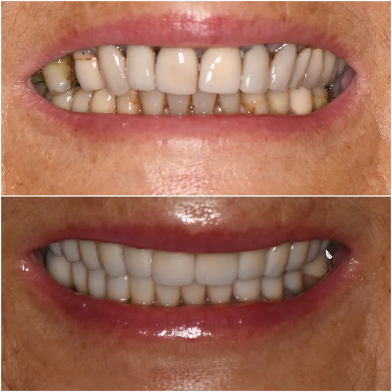 Before and after: Restorative Excellence at Thrive Dental in Bayside, Queens