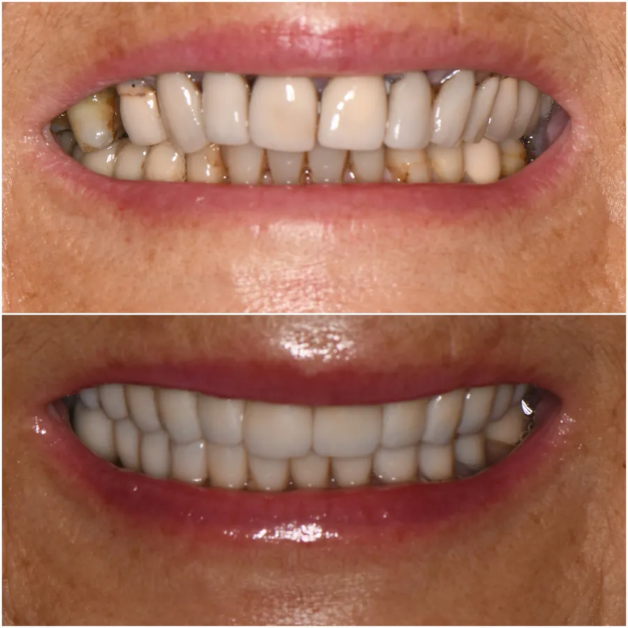 Restorative Excellence — before and after at Thrive Dental in Bayside, Queens