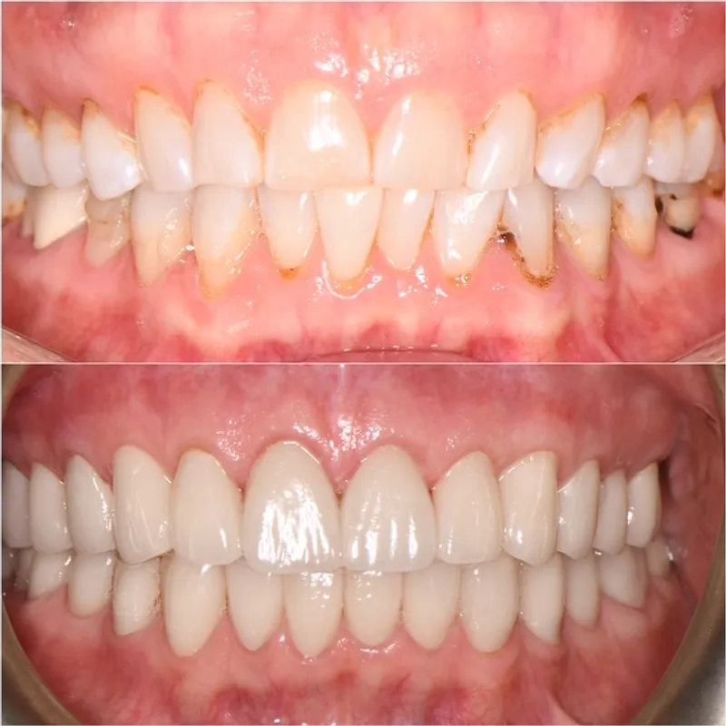 Before and after: Smile Makeover at Thrive Dental in Bayside, Queens