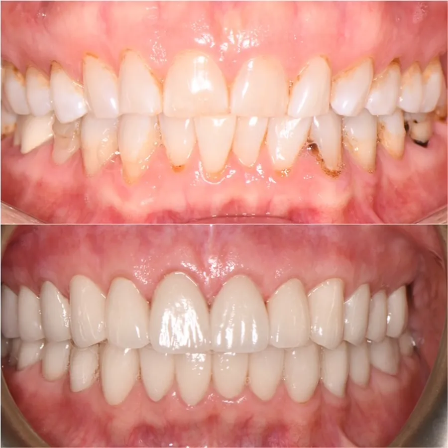 Smile Makeover — before and after at Thrive Dental in Bayside, Queens